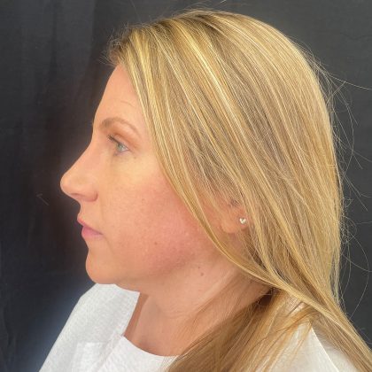 Rhinoplasty Before & After Patient #12094