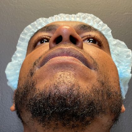 Rhinoplasty Before & After Patient #12096