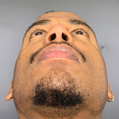 Rhinoplasty Before & After Patient #12096