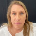 Rhinoplasty Before & After Patient #12094