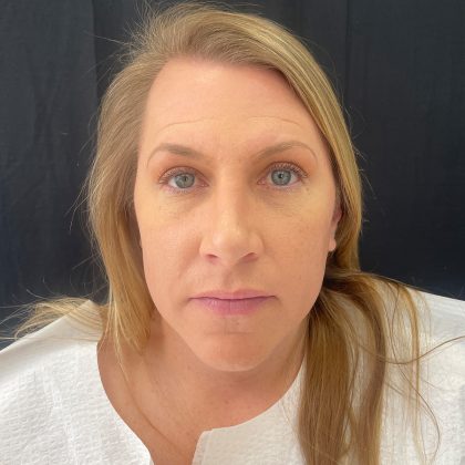 Rhinoplasty Before & After Patient #12094