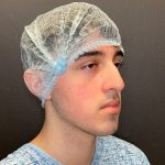 Rhinoplasty Before & After Patient #12093