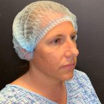 Rhinoplasty Before & After Patient #12094