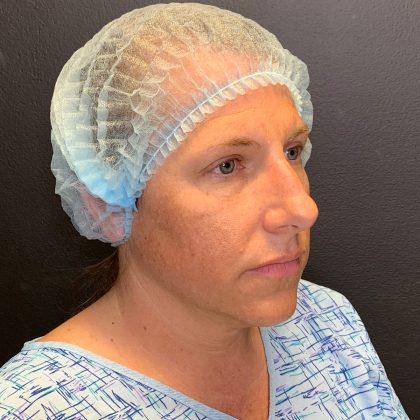 Rhinoplasty Before & After Patient #12094