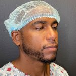 Rhinoplasty Before & After Patient #12096