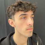 Rhinoplasty Before & After Patient #12093