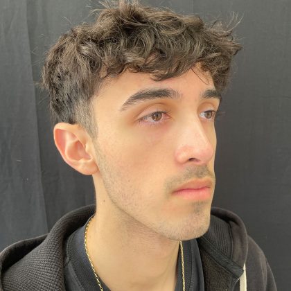 Rhinoplasty Before & After Patient #12093