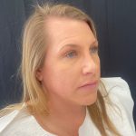 Rhinoplasty Before & After Patient #12094