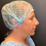 Rhinoplasty Before & After Patient #12094