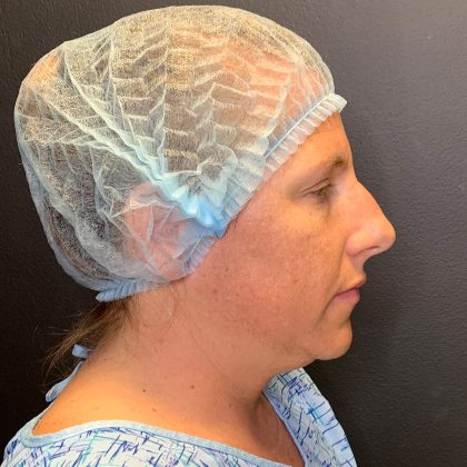 Rhinoplasty Before & After Patient #12094