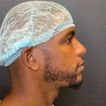 Rhinoplasty Before & After Patient #12096