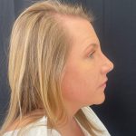 Rhinoplasty Before & After Patient #12094
