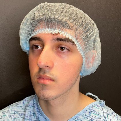 Rhinoplasty Before & After Patient #12093