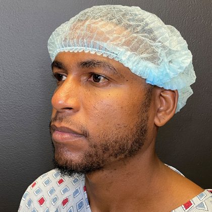 Rhinoplasty Before & After Patient #12096