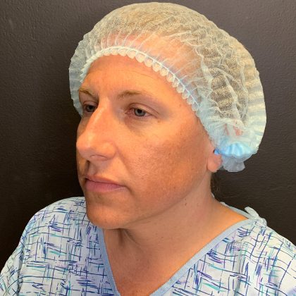 Rhinoplasty Before & After Patient #12094