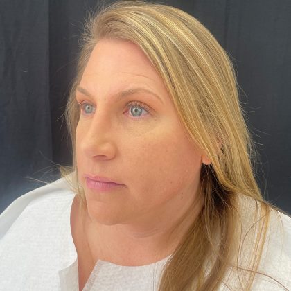 Rhinoplasty Before & After Patient #12094