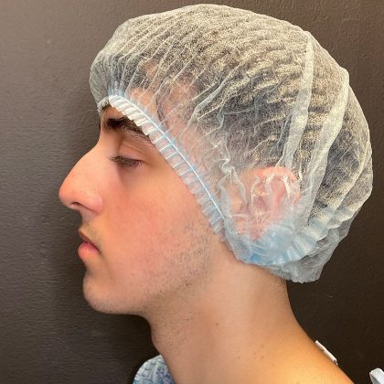 Rhinoplasty Before & After Patient #12093
