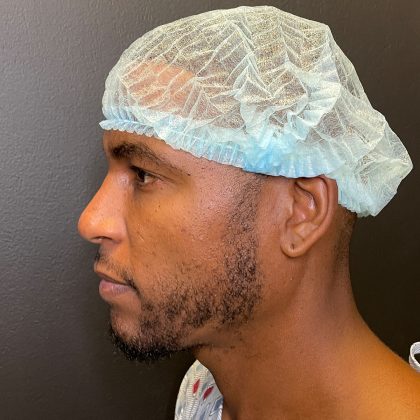 Rhinoplasty Before & After Patient #12096