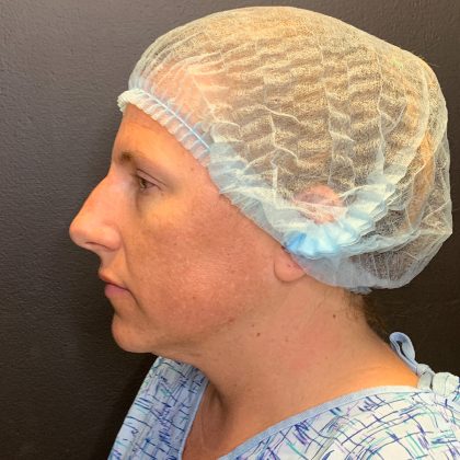 Rhinoplasty Before & After Patient #12094