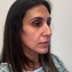 Rhinoplasty Before & After Patient #12153