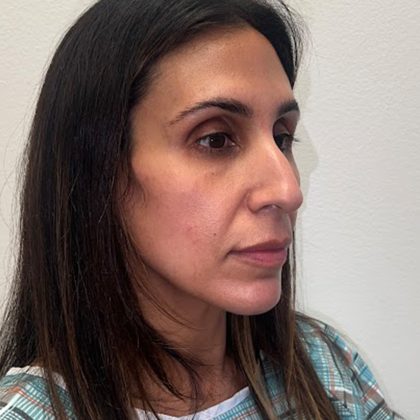 Rhinoplasty Before & After Patient #12153