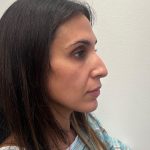 Rhinoplasty Before & After Patient #12153