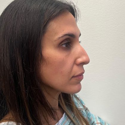 Rhinoplasty Before & After Patient #12153