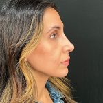 Rhinoplasty Before & After Patient #12153