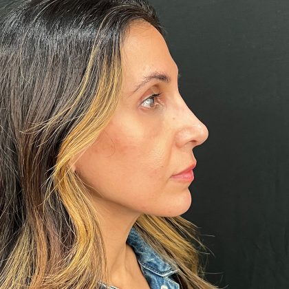 Rhinoplasty Before & After Patient #12153