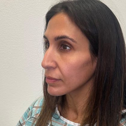 Rhinoplasty Before & After Patient #12153