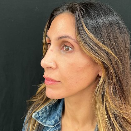 Rhinoplasty Before & After Patient #12153