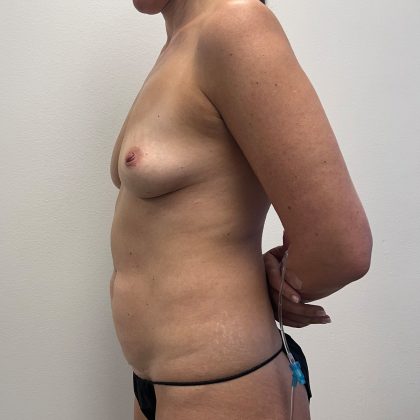 Mommy Makeover Before & After Patient #12163
