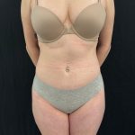 Brazilian Butt Lift Before & After Patient #12175