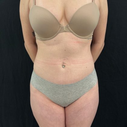 Brazilian Butt Lift Before & After Patient #12175