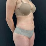 Brazilian Butt Lift Before & After Patient #12175