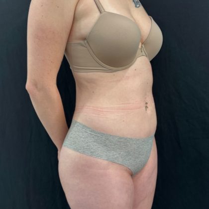 Brazilian Butt Lift Before & After Patient #12175