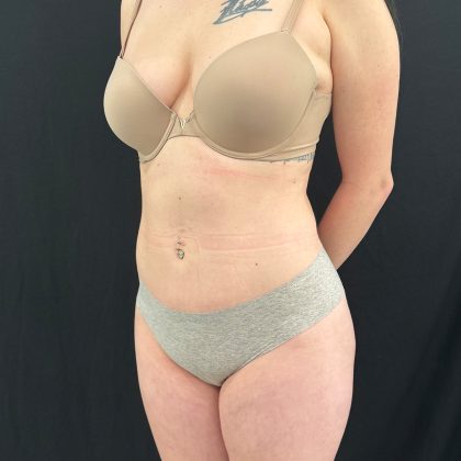 Brazilian Butt Lift Before & After Patient #12175