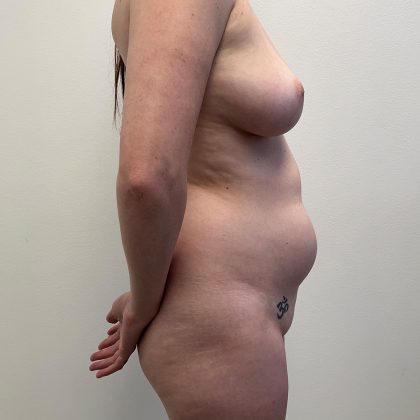 Brazilian Butt Lift Before & After Patient #12175