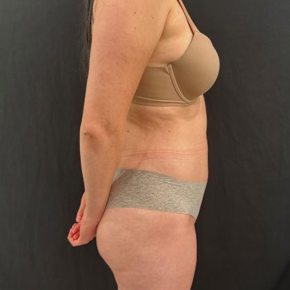 Brazilian Butt Lift Before & After Patient #12175