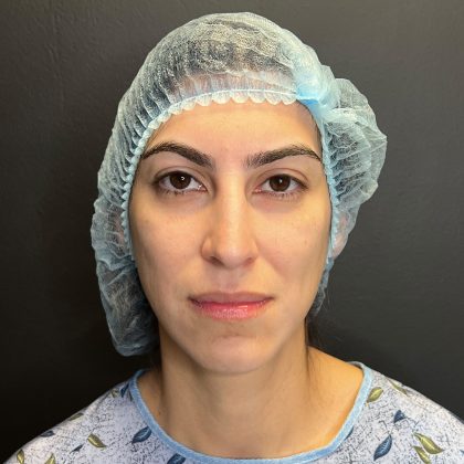 Rhinoplasty Before & After Patient #12184