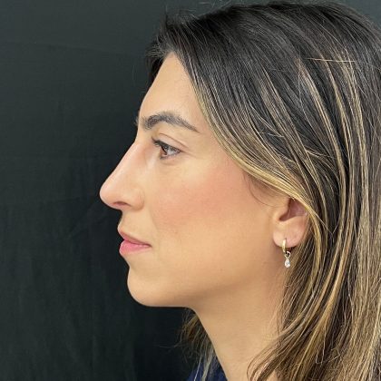 Rhinoplasty Before & After Patient #12184