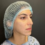 Rhinoplasty Before & After Patient #12184