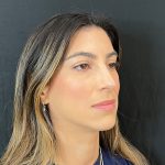 Rhinoplasty Before & After Patient #12184