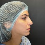 Rhinoplasty Before & After Patient #12184