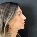 Rhinoplasty Before & After Patient #12184