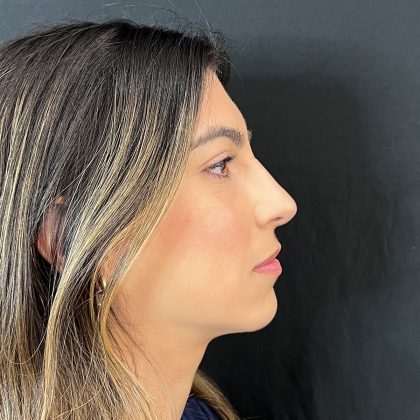Rhinoplasty Before & After Patient #12184