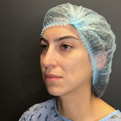 Rhinoplasty Before & After Patient #12184