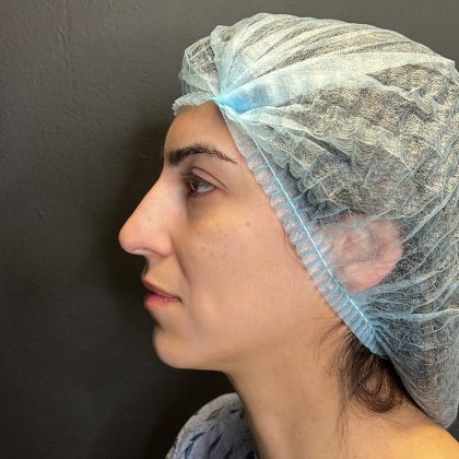Rhinoplasty Before & After Patient #12184