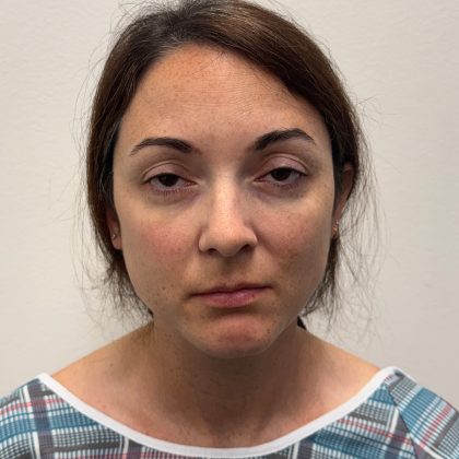 Rhinoplasty Before & After Patient #12095