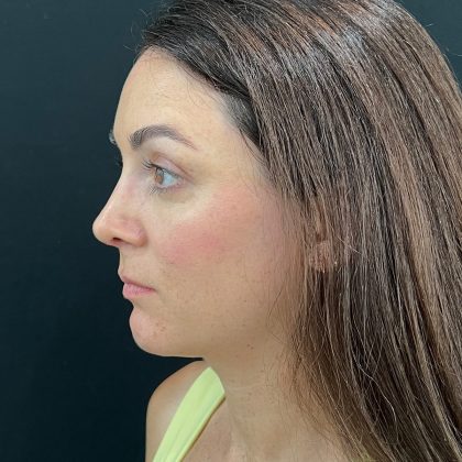 Rhinoplasty Before & After Patient #12095